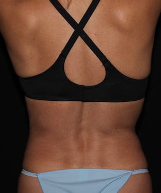 Liposuction Before & After Gallery - Patient 133023845 - Image 10