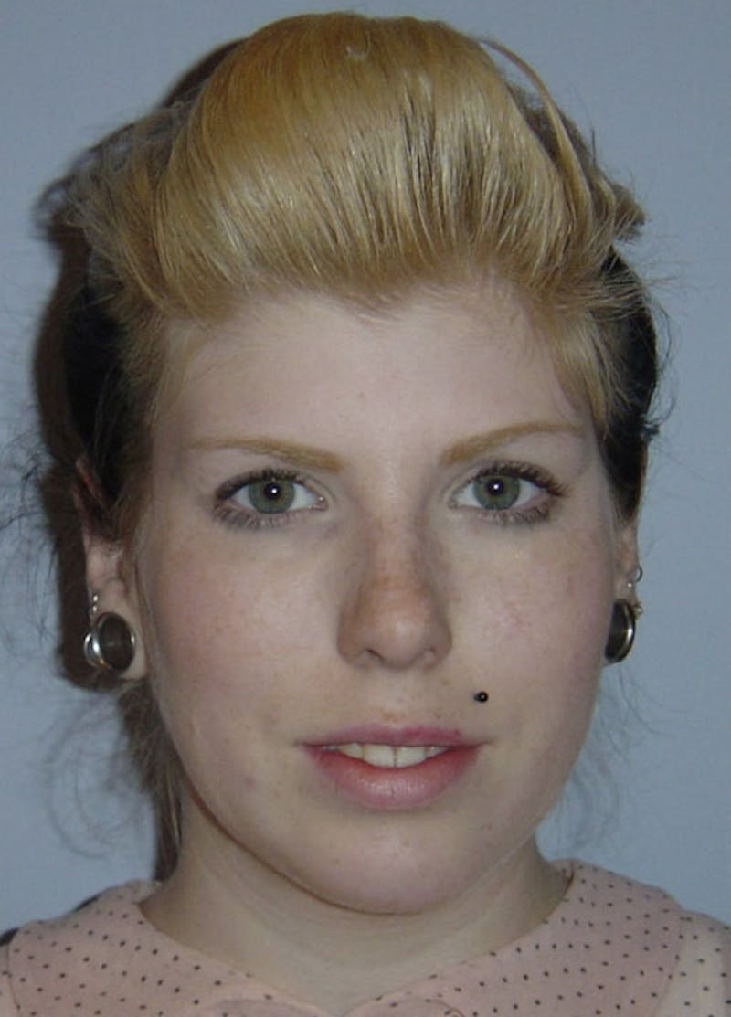 Chin Implants Before & After Gallery - Patient 133023846 - Image 3