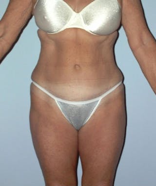Tummy Tuck Before & After Gallery - Patient 133023849 - Image 2