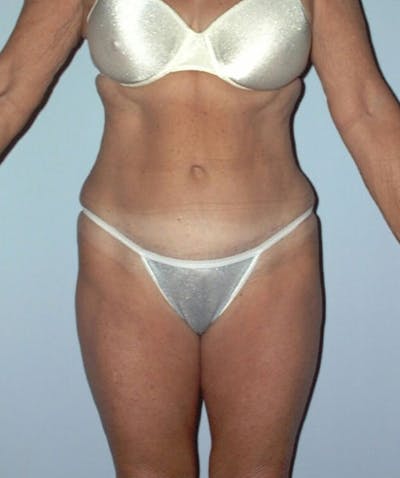 Tummy Tuck Before & After Gallery - Patient 133023849 - Image 2
