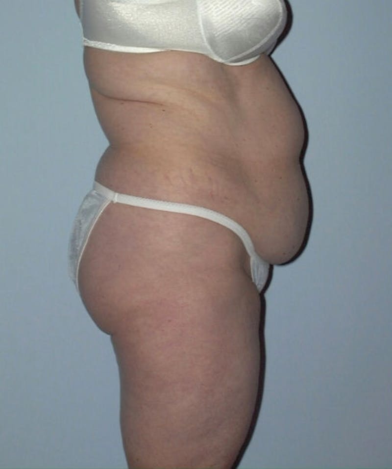 Tummy Tuck Before & After Gallery - Patient 133023849 - Image 3
