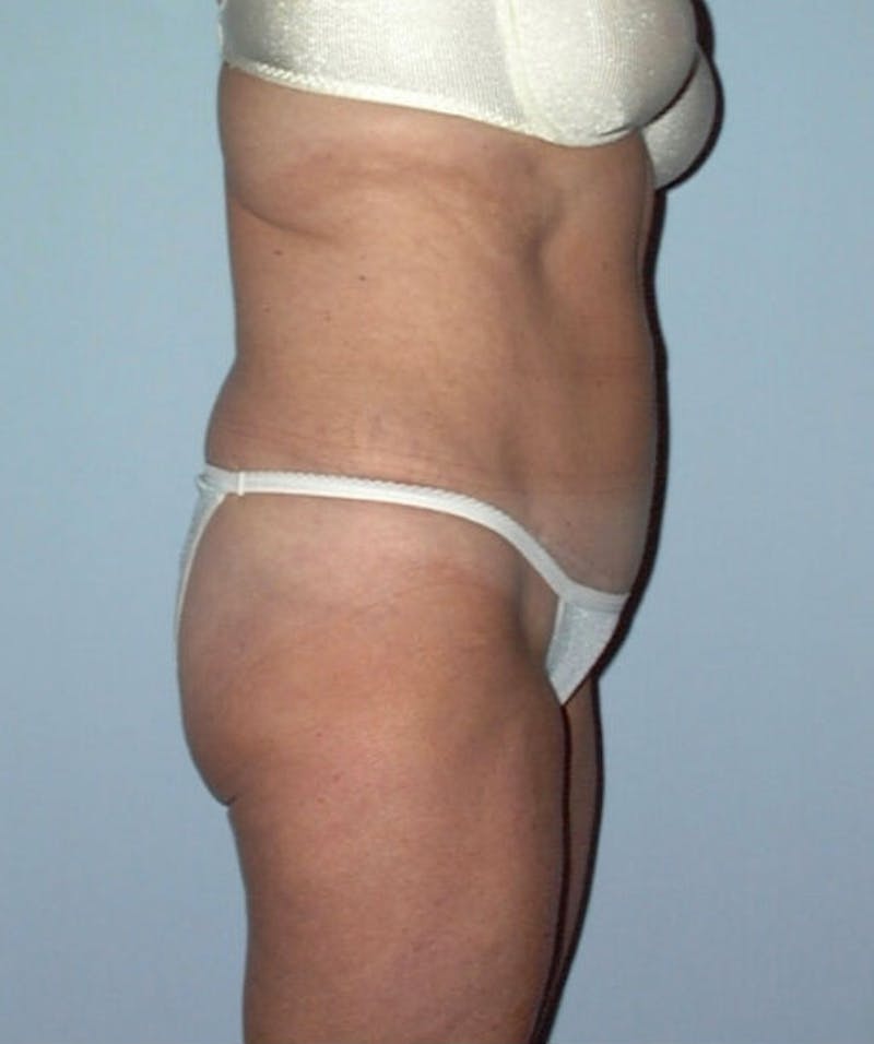 Tummy Tuck Before & After Gallery - Patient 133023849 - Image 4