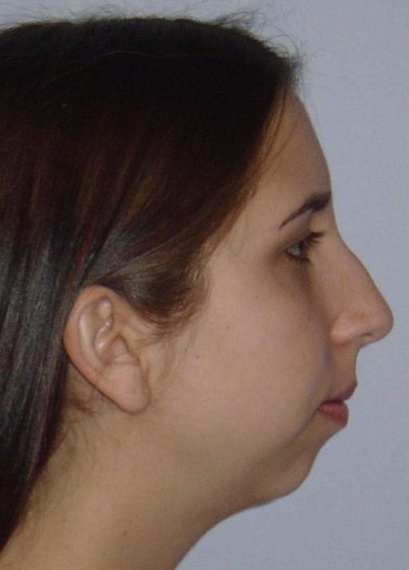 Chin Implants Before & After Gallery - Patient 133023852 - Image 1