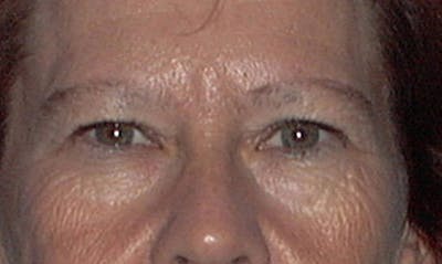 Eyelid Surgery Before & After Gallery - Patient 133023853 - Image 1