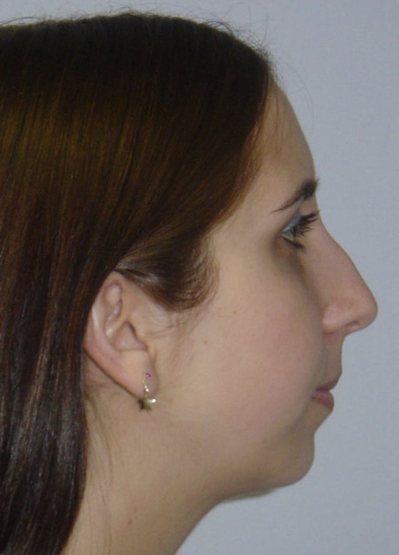 Chin Implants Before & After Gallery - Patient 133023852 - Image 2