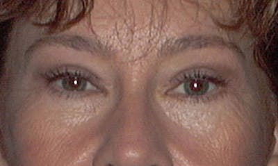 Eyelid Surgery Before & After Gallery - Patient 133023853 - Image 2