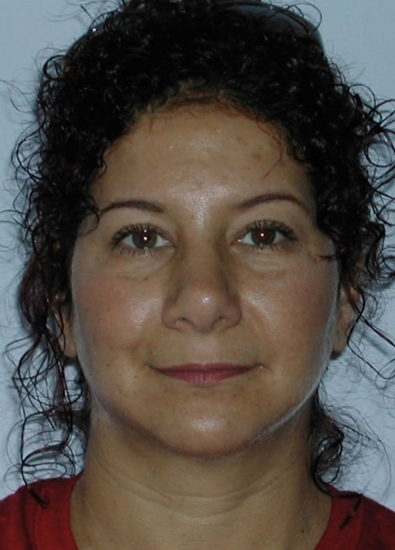 Brow Lift Before & After Gallery - Patient 133023855 - Image 2