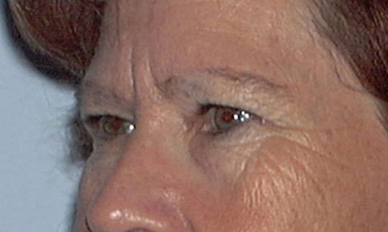 Eyelid Surgery Before & After Gallery - Patient 133023853 - Image 3