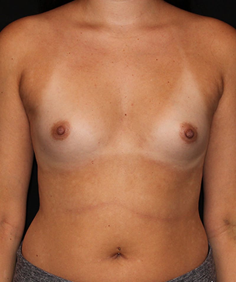 Breast Augmentation Before & After Gallery - Patient 133023870 - Image 1
