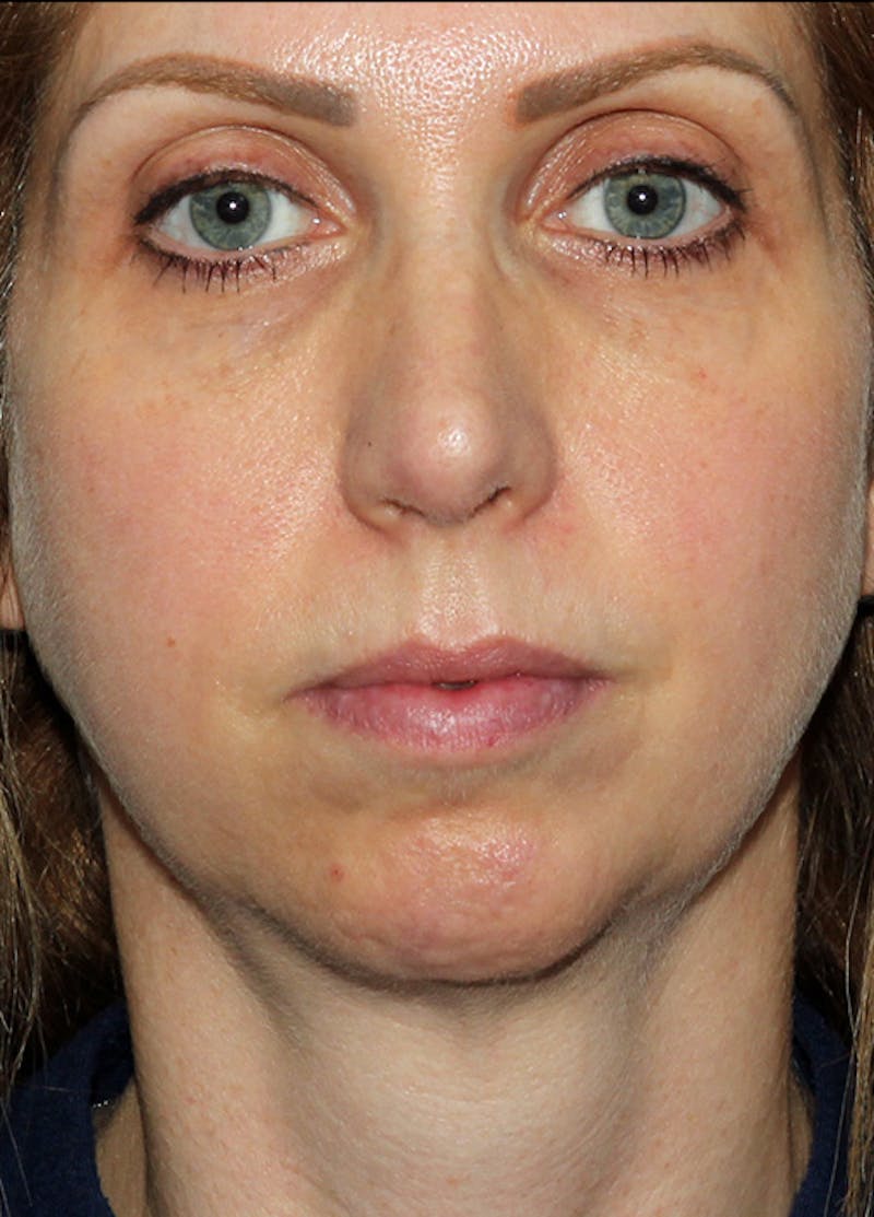 Chin Implants Before & After Gallery - Patient 133023863 - Image 1