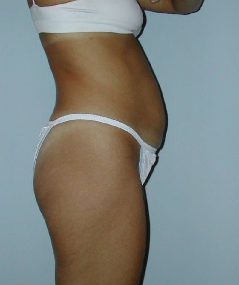 Tummy Tuck Before & After Gallery - Patient 133023854 - Image 3