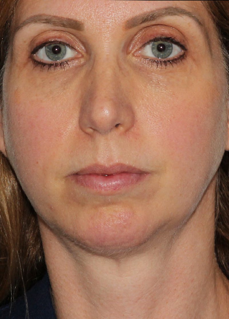Chin Implants Before & After Gallery - Patient 133023863 - Image 2