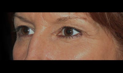 Eyelid Surgery Before & After Gallery - Patient 133023862 - Image 1