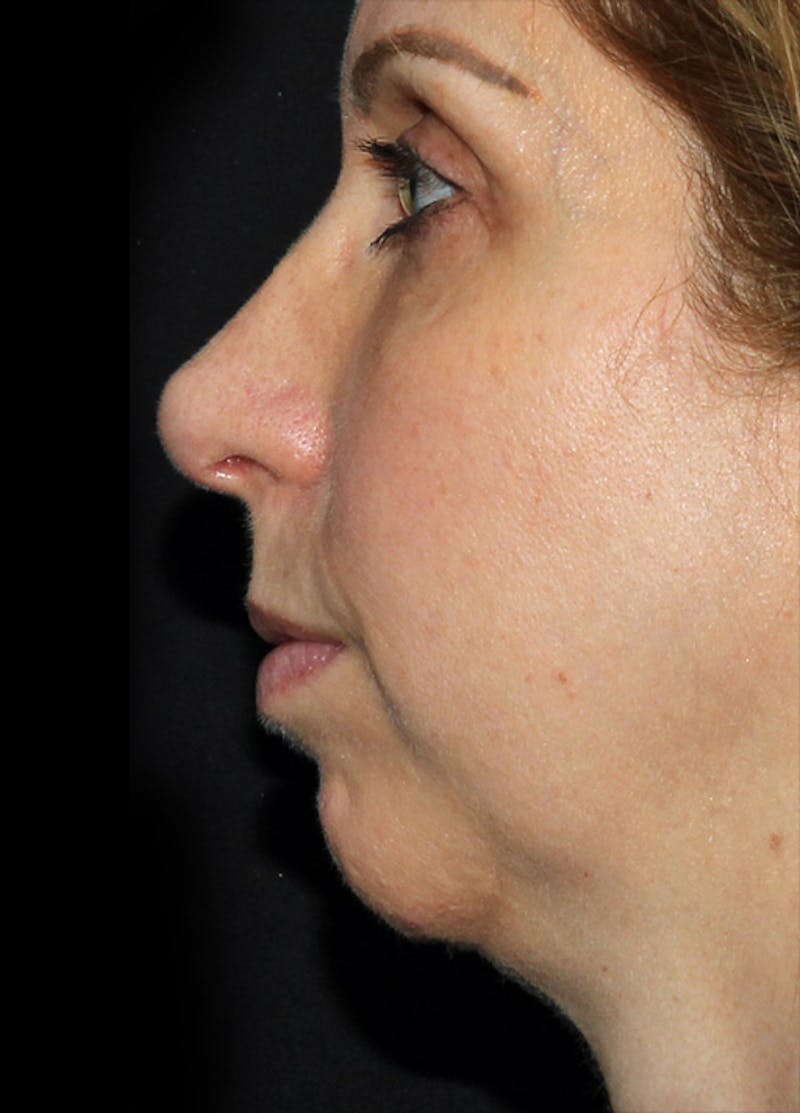 Chin Implants Before & After Gallery - Patient 133023863 - Image 3