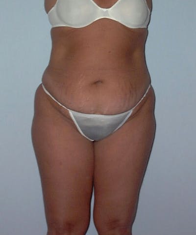Tummy Tuck Before & After Gallery - Patient 133023858 - Image 1