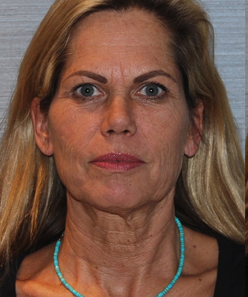 Brow Lift Before & After Gallery - Patient 133023872 - Image 1
