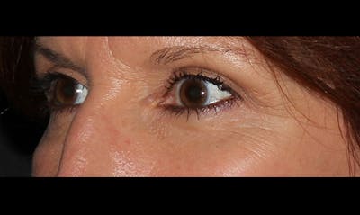 Eyelid Surgery Before & After Gallery - Patient 133023862 - Image 2
