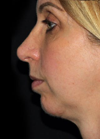 Chin Implants Before & After Gallery - Patient 133023863 - Image 4