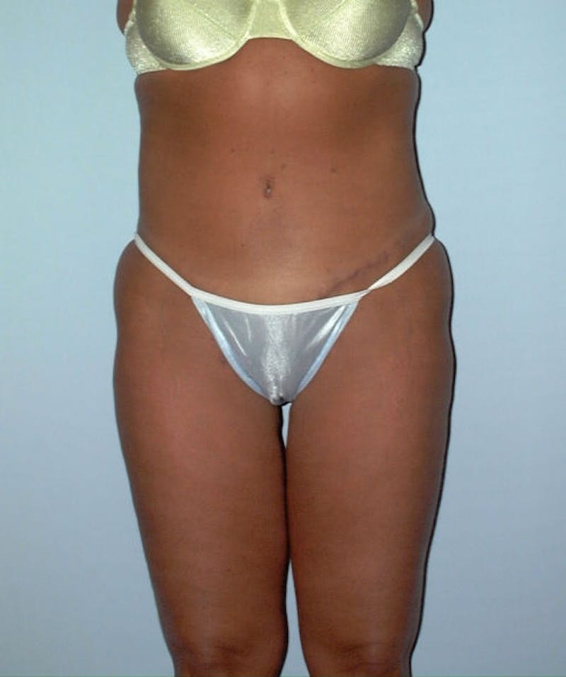 Tummy Tuck Before & After Gallery - Patient 133023858 - Image 2