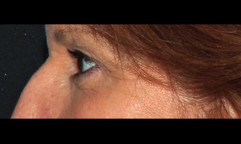 Eyelid Surgery Before & After Gallery - Patient 133023862 - Image 3