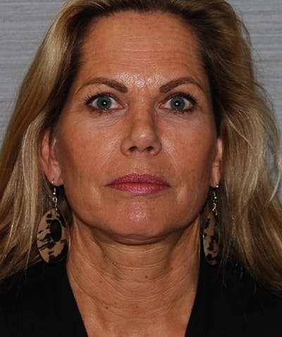 Brow Lift Before & After Gallery - Patient 133023872 - Image 2
