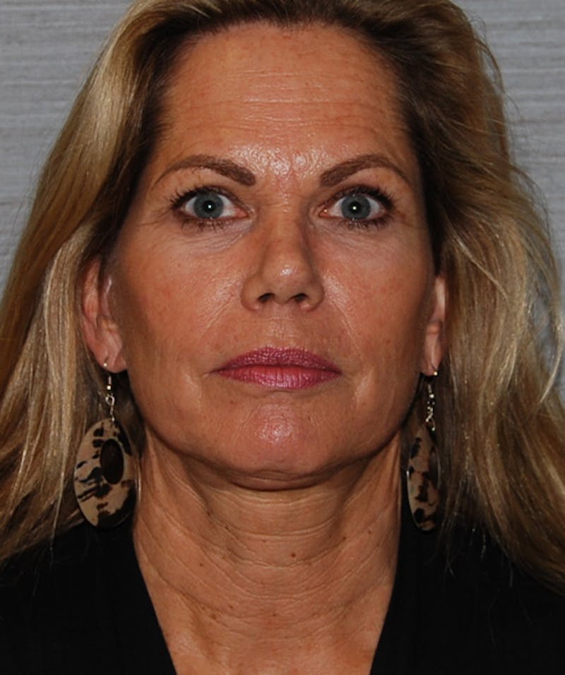 Brow Lift Before & After Gallery - Patient 133023872 - Image 2