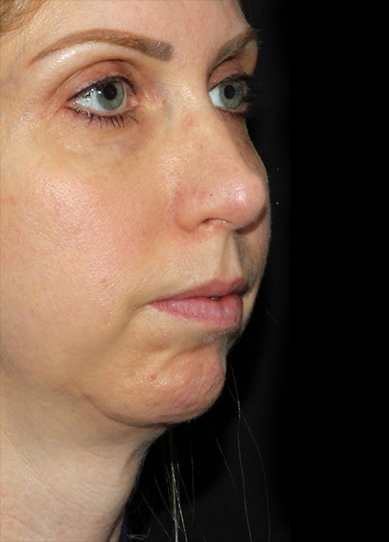 Chin Implants Before & After Gallery - Patient 133023863 - Image 5