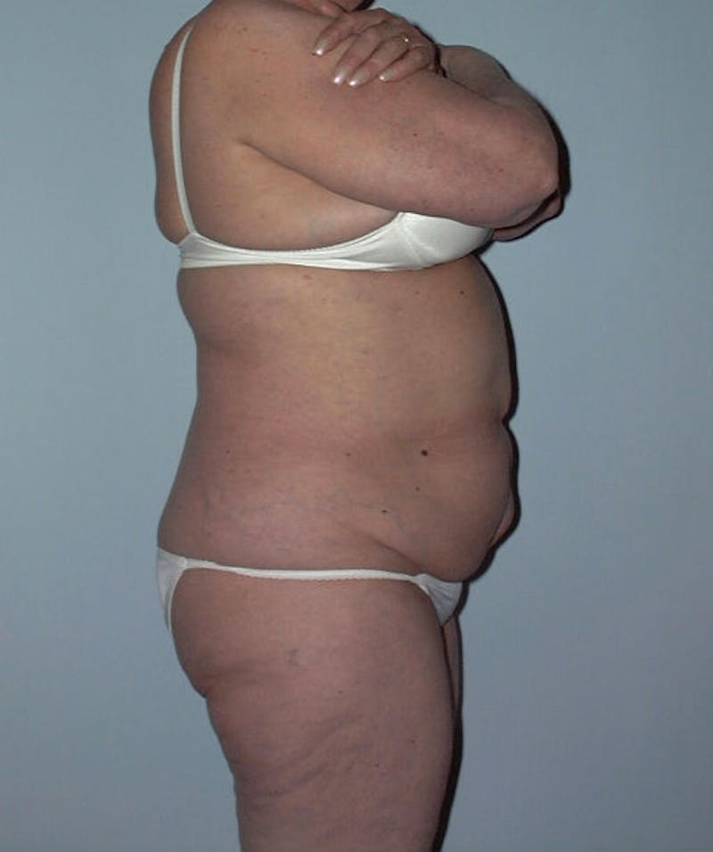 Tummy Tuck Before & After Gallery - Patient 133023864 - Image 1