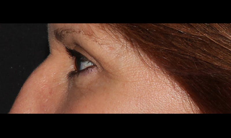Eyelid Surgery Before & After Gallery - Patient 133023862 - Image 4