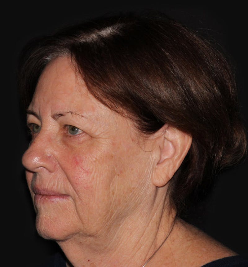 Facelift & Necklift Before & After Gallery - Patient 133023868 - Image 1