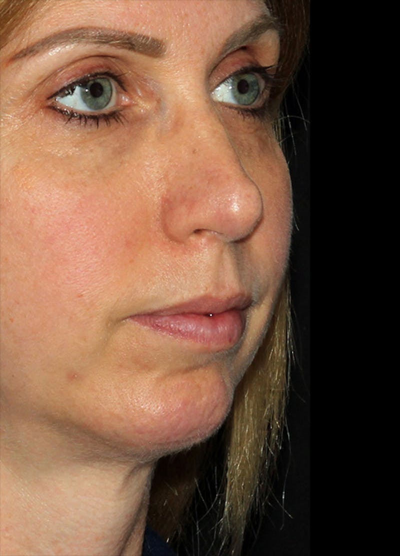 Chin Implants Before & After Gallery - Patient 133023863 - Image 6