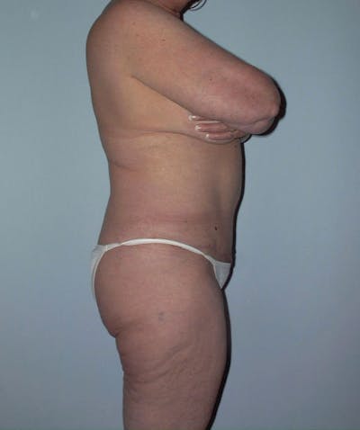 Tummy Tuck Before & After Gallery - Patient 133023864 - Image 2