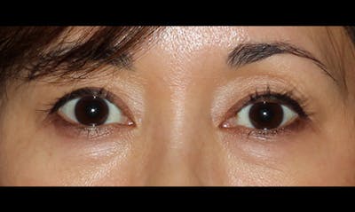 Eyelid Surgery Before & After Gallery - Patient 133023869 - Image 1