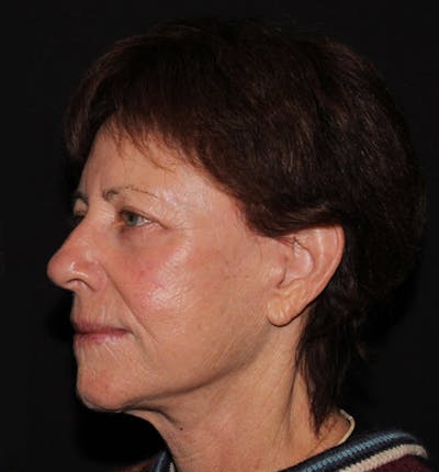 Facelift & Necklift Before & After Gallery - Patient 133023868 - Image 2