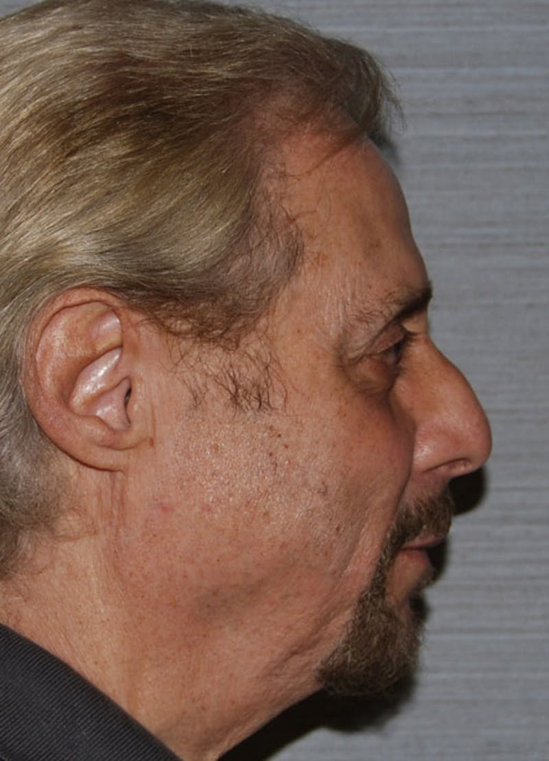 Chin Implants Before & After Gallery - Patient 133023867 - Image 1