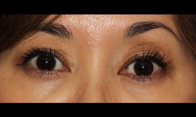 Eyelid Surgery Before & After Gallery - Patient 133023869 - Image 2
