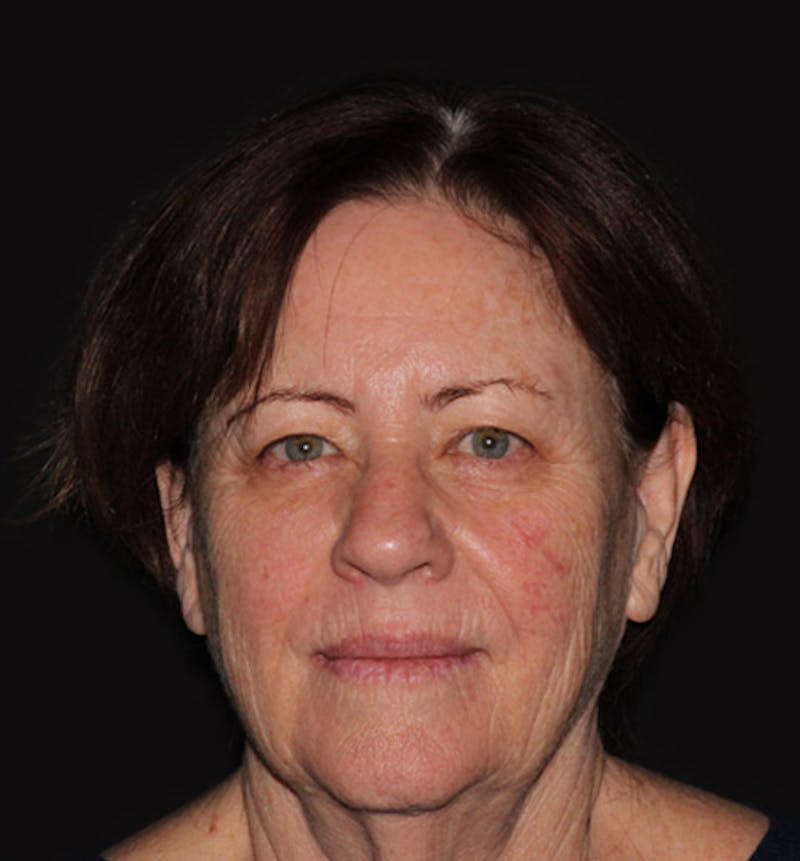 Facelift & Necklift Before & After Gallery - Patient 133023868 - Image 3