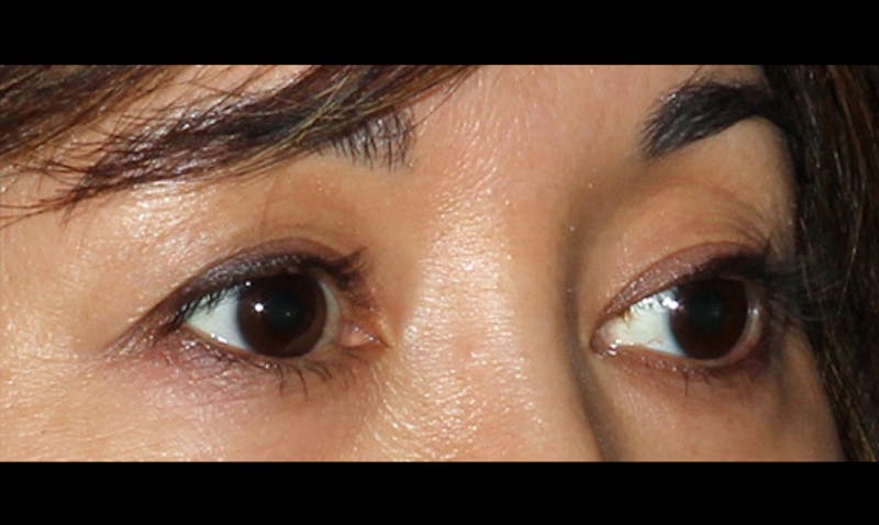 Eyelid Surgery Before & After Gallery - Patient 133023869 - Image 3