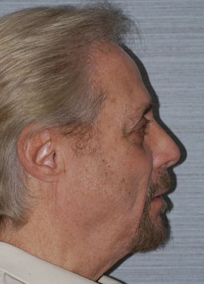 Chin Implants Before & After Gallery - Patient 133023867 - Image 2