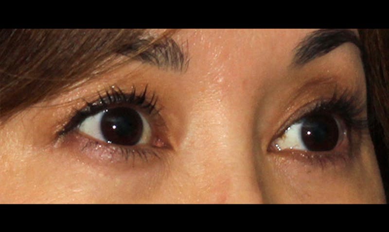 Eyelid Surgery Before & After Gallery - Patient 133023869 - Image 4