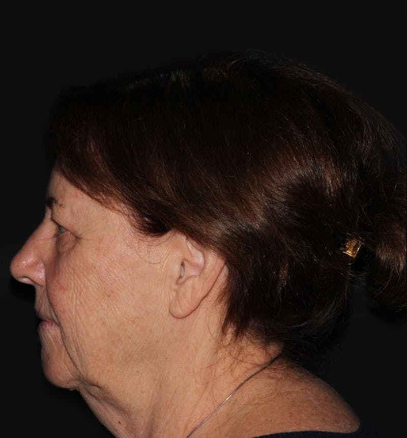 Facelift & Necklift Before & After Gallery - Patient 133023868 - Image 5