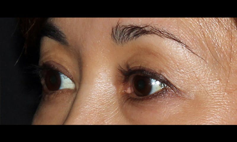 Eyelid Surgery Before & After Gallery - Patient 133023869 - Image 5