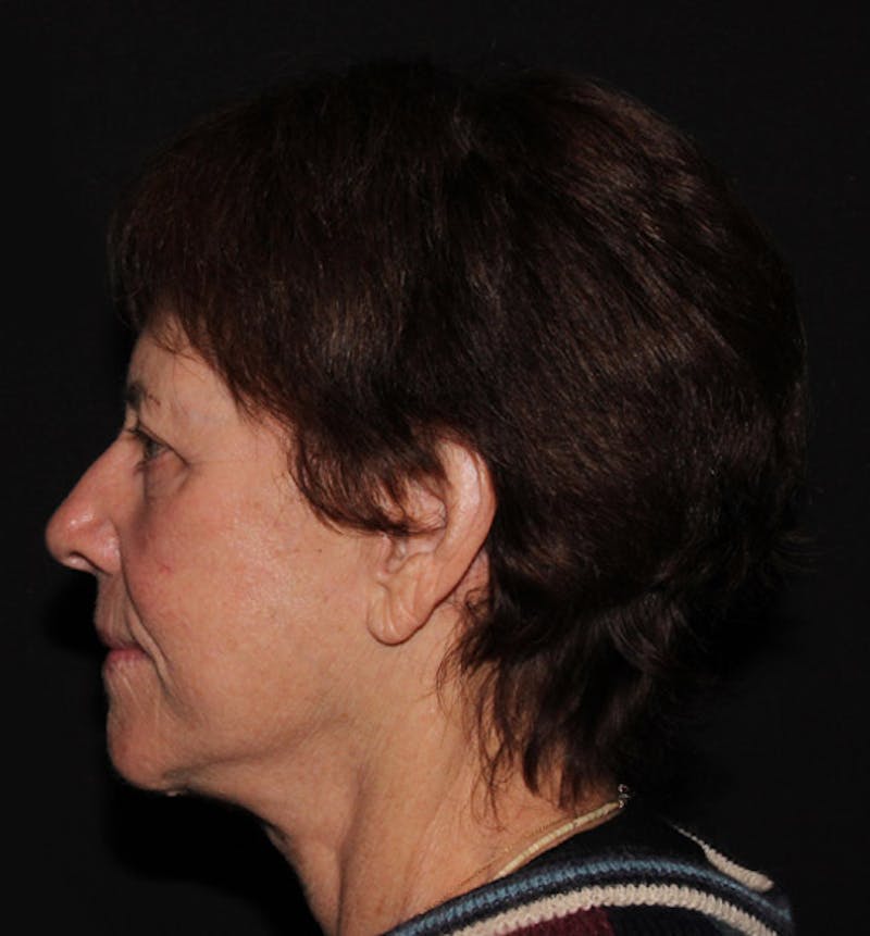 Facelift & Necklift Before & After Gallery - Patient 133023868 - Image 6