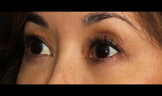 Eyelid Surgery Before & After Gallery - Patient 133023869 - Image 6