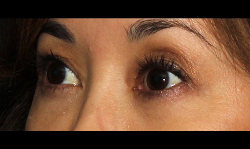 Eyelid Surgery Before & After Gallery - Patient 133023869 - Image 6