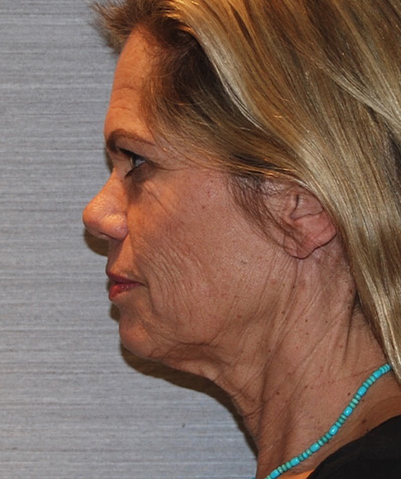 Brow Lift Before & After Gallery - Patient 133023872 - Image 9