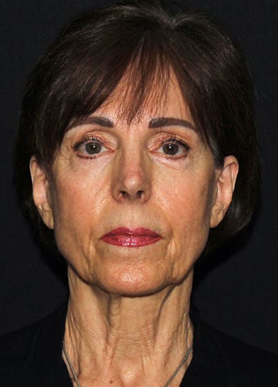 Facelift & Necklift Before & After Gallery - Patient 133023880 - Image 1