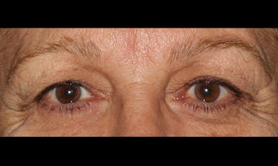 Eyelid Surgery Before & After Gallery - Patient 133023878 - Image 1