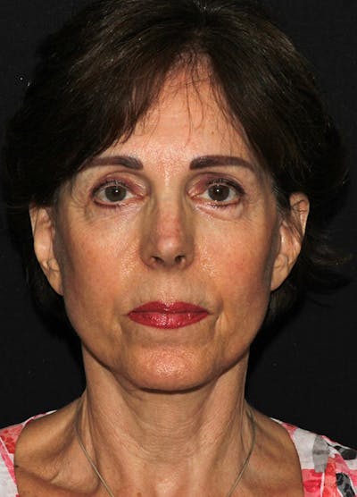 Facelift & Necklift Before & After Gallery - Patient 133023880 - Image 2