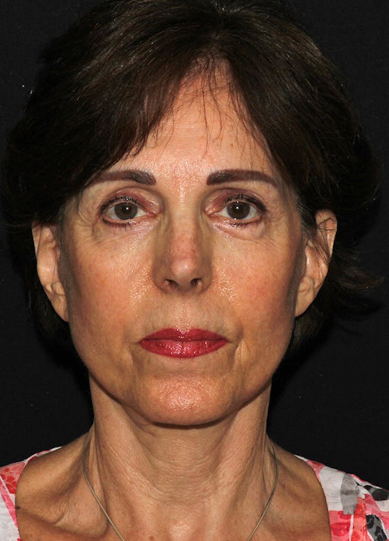 Facelift & Necklift Before & After Gallery - Patient 133023880 - Image 2